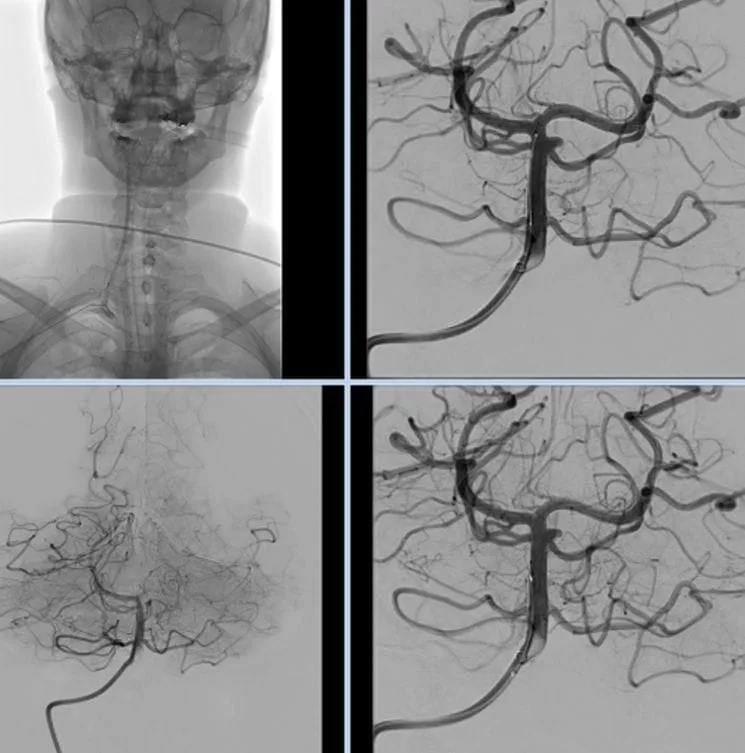 Gehirnangiographie BEYIN ANJIYO Behandlungsbild der Hirnangiographie