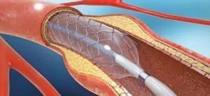 Ballon- und Stentanwendungen Balon Ve Stent Uygulamalari
