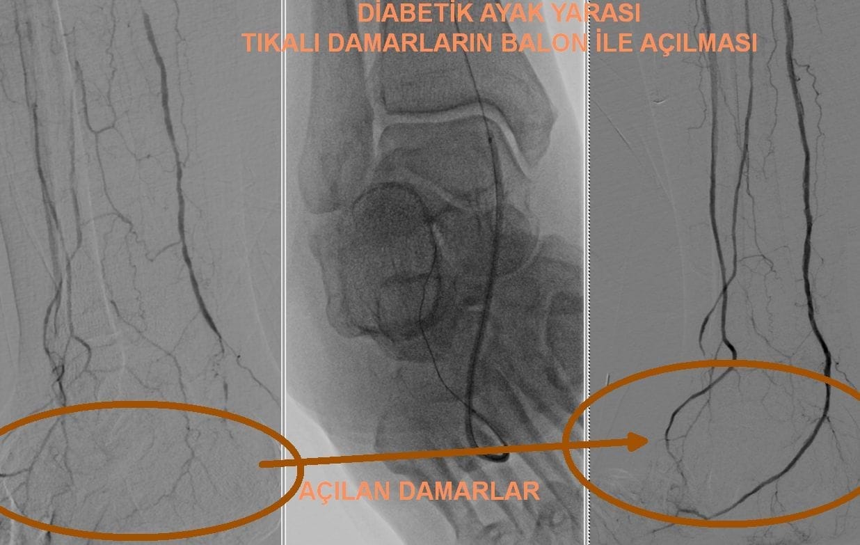 Non-Healing Diabetic Foot Wounds DIABETIK AYAK YARASI Balloon procedure for a DIABETIC FOOT ULCER
