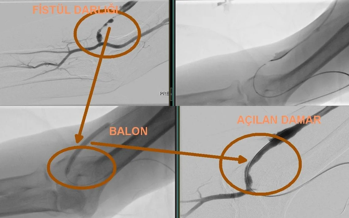 Dialysis Fistula Blockage Treatment: Angioplasty, Thrombectomy and Stenting FISTUL DAMAR PROBLEMLERI Opening of fistula vessel problems
