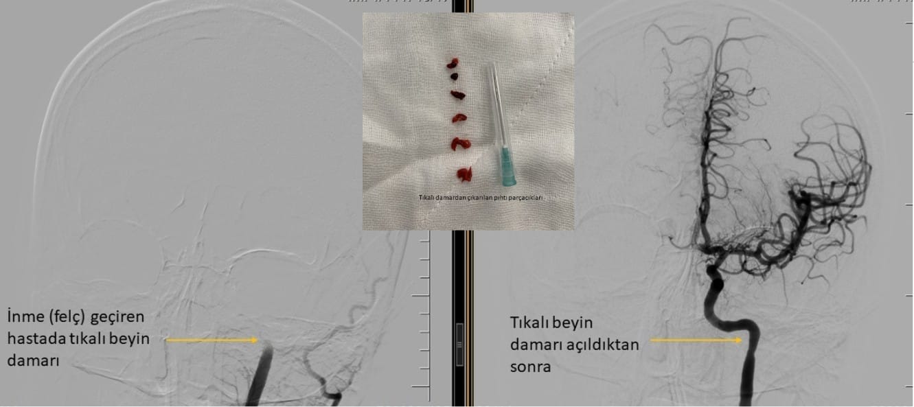 Beyin Anjiyosu Nedir? Neden & Nasıl Yapılır? Riskleri Nelerdir? ani beyin felci tedavisi Vücut sağ yarısında ani kuvvet kaybı olan hasta 3. saatte hastaneye ulaştırıldığından anjiyo ile kafa içi pıhtı çıkarıldı ve konuşma bozukluğu ve felç ertesi gün geriledi, hasta 1 hafta sonra taburcu edildi. Önemli not: Ani beyin felci ataklarında ilk 6 saatte bu tedaviyi uygulayabiliyoruz, o nedenle gecikmemek çok önemli!