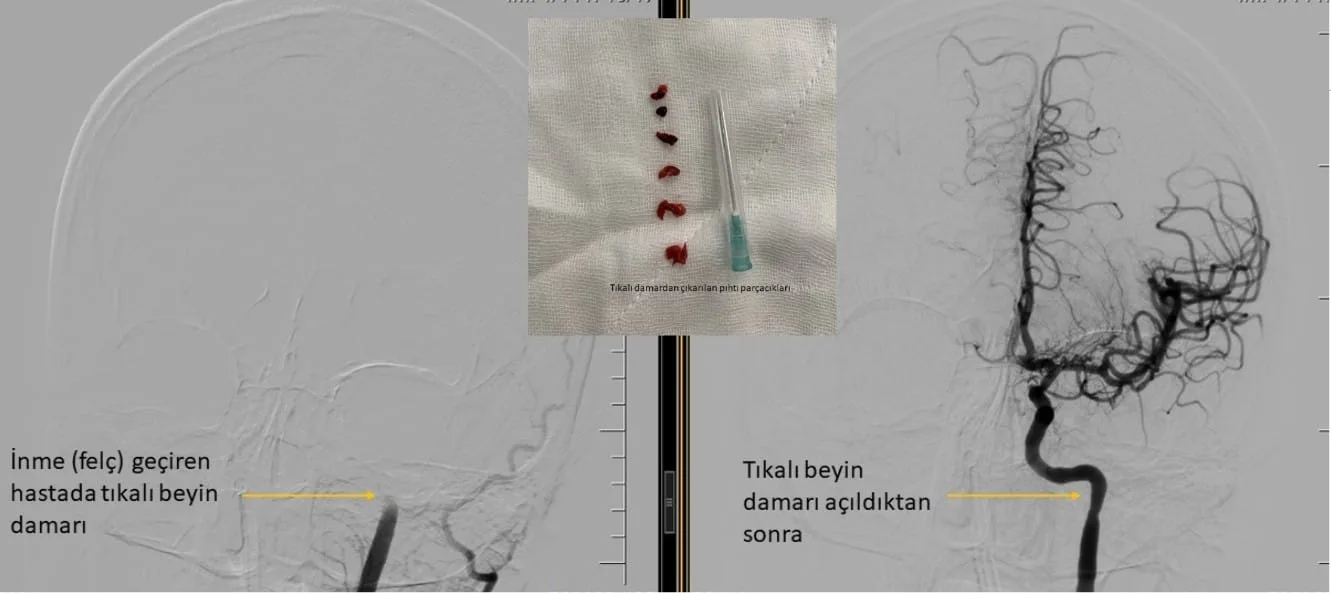 Brain Angiography (Cerebral Angiography): Procedure, Uses, Risks and Recovery ani beyin felci tedavisi Patient with sudden right‑side weakness treated by angiographic clot removal at 3 hours, speech and paralysis improved by next day, discharged after one week. Note: This treatment can be applied within 6 hours of stroke onset—timeliness is crucial!