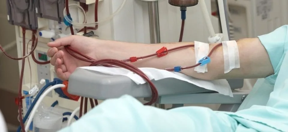Öffnung von verstopften Dialysefisteln diyaliz damar hastaliklari kapak