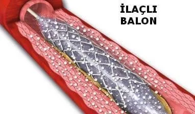 New Technologies in Interventional Radiology: Advances and Treatment Methods ilacli balon New Technologies in Interventional Radiology: Advances and Treatment Methods ilacli balon