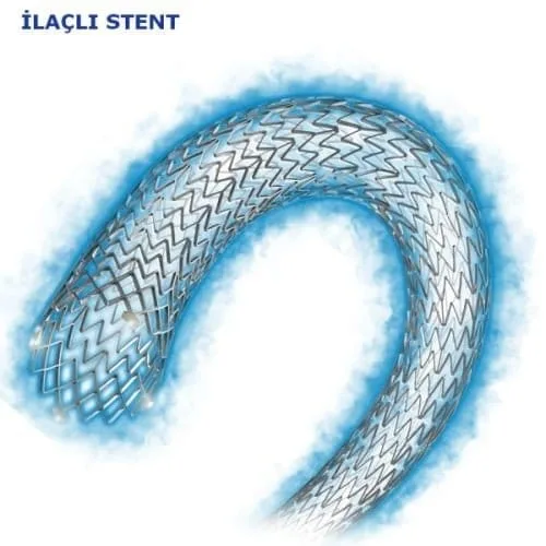 New Technologies in Interventional Radiology: Advances and Treatment Methods ilacli stent New Technologies in Interventional Radiology: Advances and Treatment Methods ilacli stent