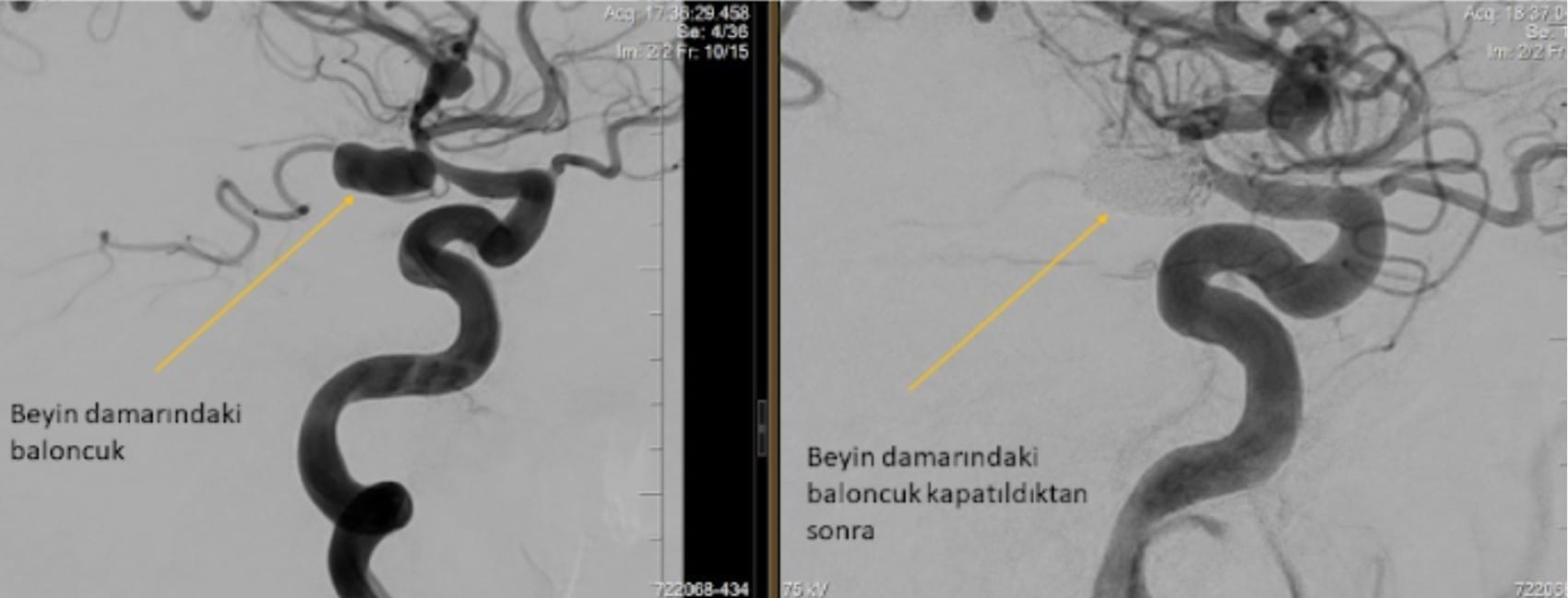 Beyin Anevrizmasının Girişimsel Tedavisi kanamis beyin anevrizmasi koil ile Tedavisi kanamış beyin anevrizması koil ile Tedavisi
