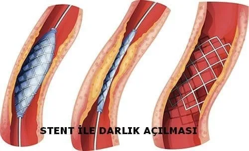 Balloon Angioplasty and Stent Placement: Procedure, Benefits, Risks and Recovery stent ile darlik acilmasi Balloon Angioplasty and Stent Placement: Procedure, Benefits, Risks and Recovery stent ile darlik acilmasi
