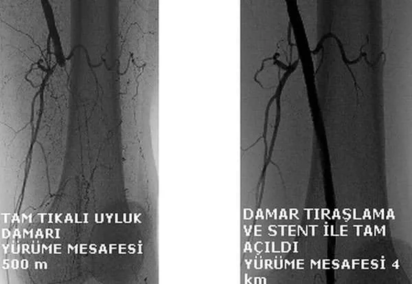 New Technologies in Interventional Radiology: Advances and Treatment Methods tikali uyluk damalari New Technologies in Interventional Radiology: Advances and Treatment Methods tikali uyluk damalari