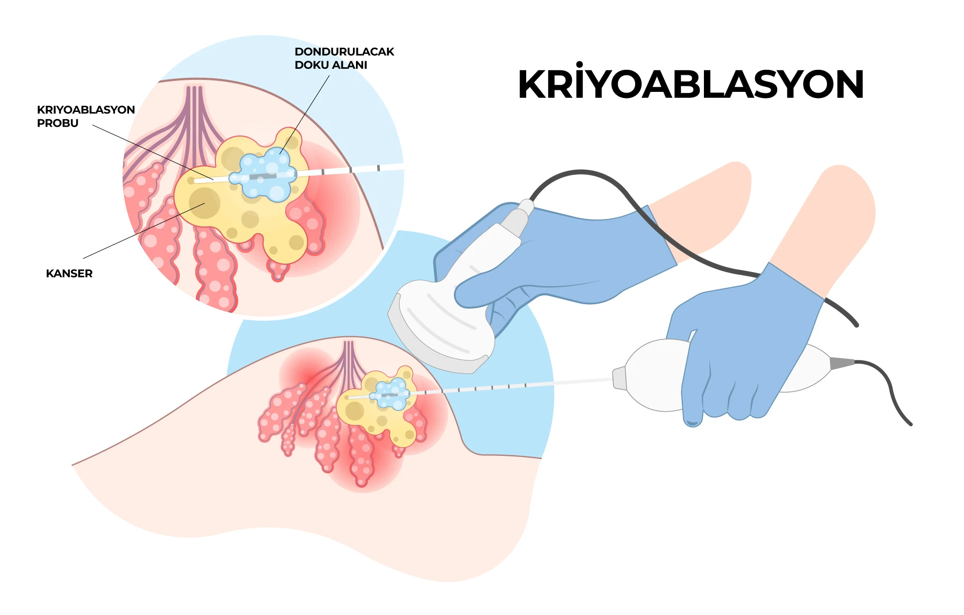 Kriyoablasyon Nedir? Hangi Kanserlerde Kullanılır? KRIYOABLASYON Kriyoablasyon Nedir? Hangi Kanserlerde Kullanılır? KRIYOABLASYON