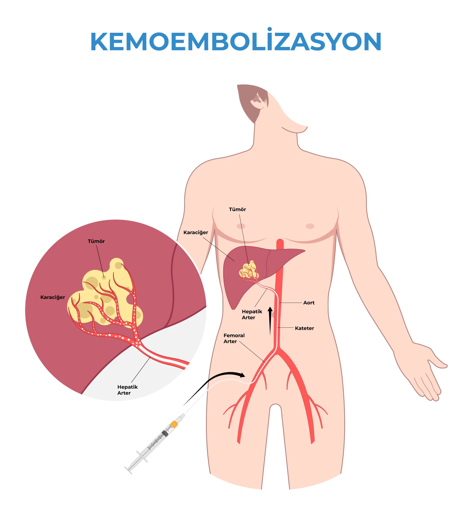 Kemoembolizasyon Nedir? Başarı Oranı ve Tedavi Süreci Kemoembolizasyon Kemoembolizasyon Nedir? Başarı Oranı ve Tedavi Süreci Kemoembolizasyon