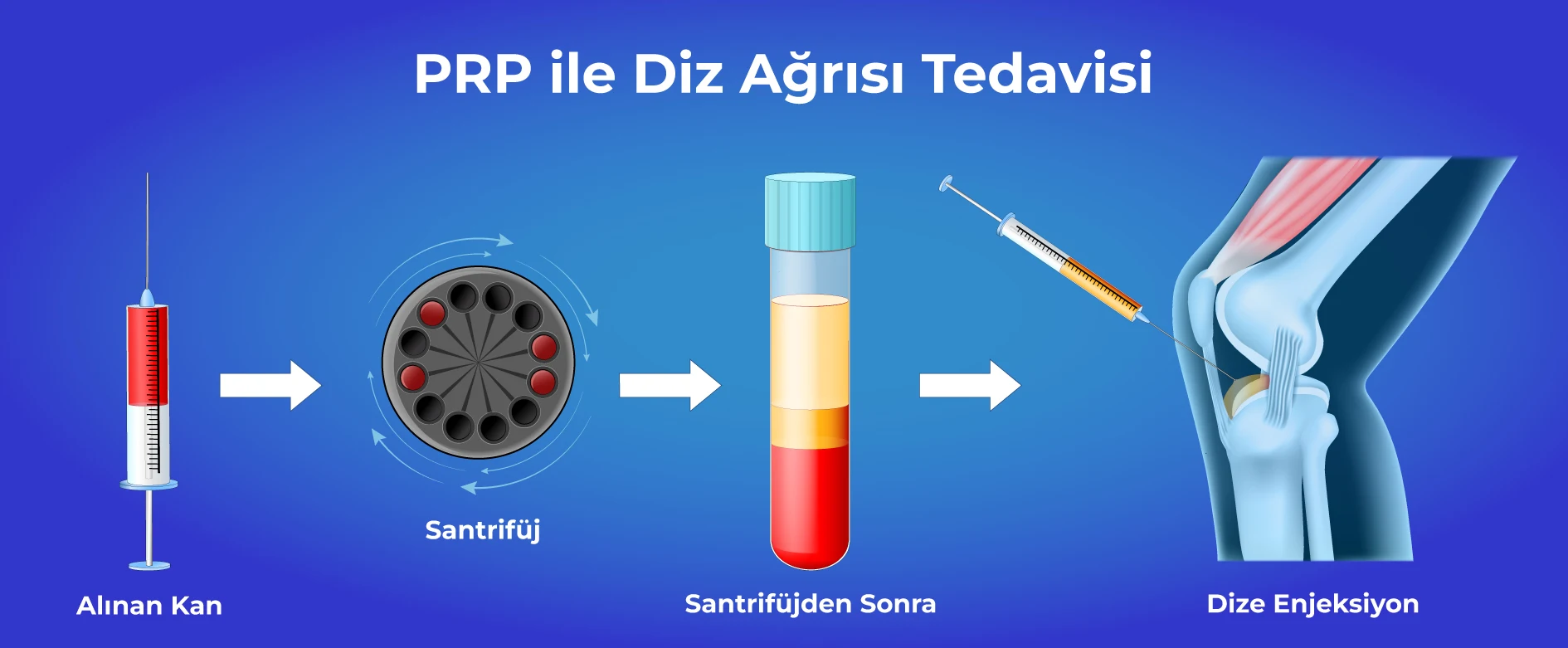 PRP ile Diz Ağrısı Tedavisi Nasıl Yapılır? PRP ile Diz Agrisi Tedavisi PRP ile Diz Ağrısı Tedavisi Nasıl Yapılır? PRP ile Diz Agrisi Tedavisi