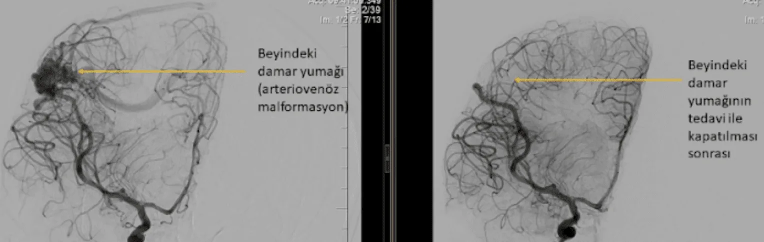 Arteriovenöz Malformasyon (AVM) Nedir? Belirtileri ve Tedavisi avm Kanamış beyin damar yumağı (AVM) embolizasyon tedavisi