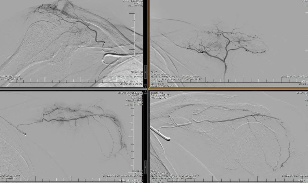 Angioembolisation bei Schulterschmerzen omuz agrisi embolizasyon once sonra omuz ağrısı embolizasyon önce sonra görüntüsü