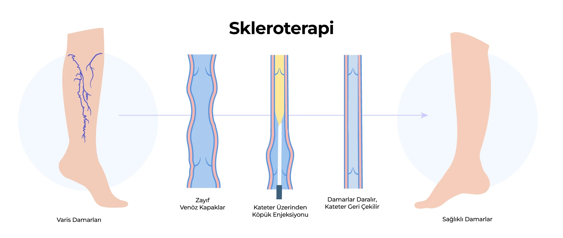 Skleroterapi Nedir? Yan Etkileri, Zararları ve Fiyatları skleroterapi Skleroterapi Nedir? Yan Etkileri, Zararları ve Fiyatları skleroterapi