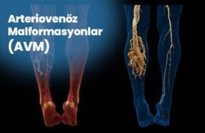 Malformații arteriovenoase (MAV) Arteriovenoz Malformasyonlar AVM