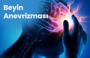 Tratamentul intervențional al anevrismului cerebral Beyin Anevrizmasi