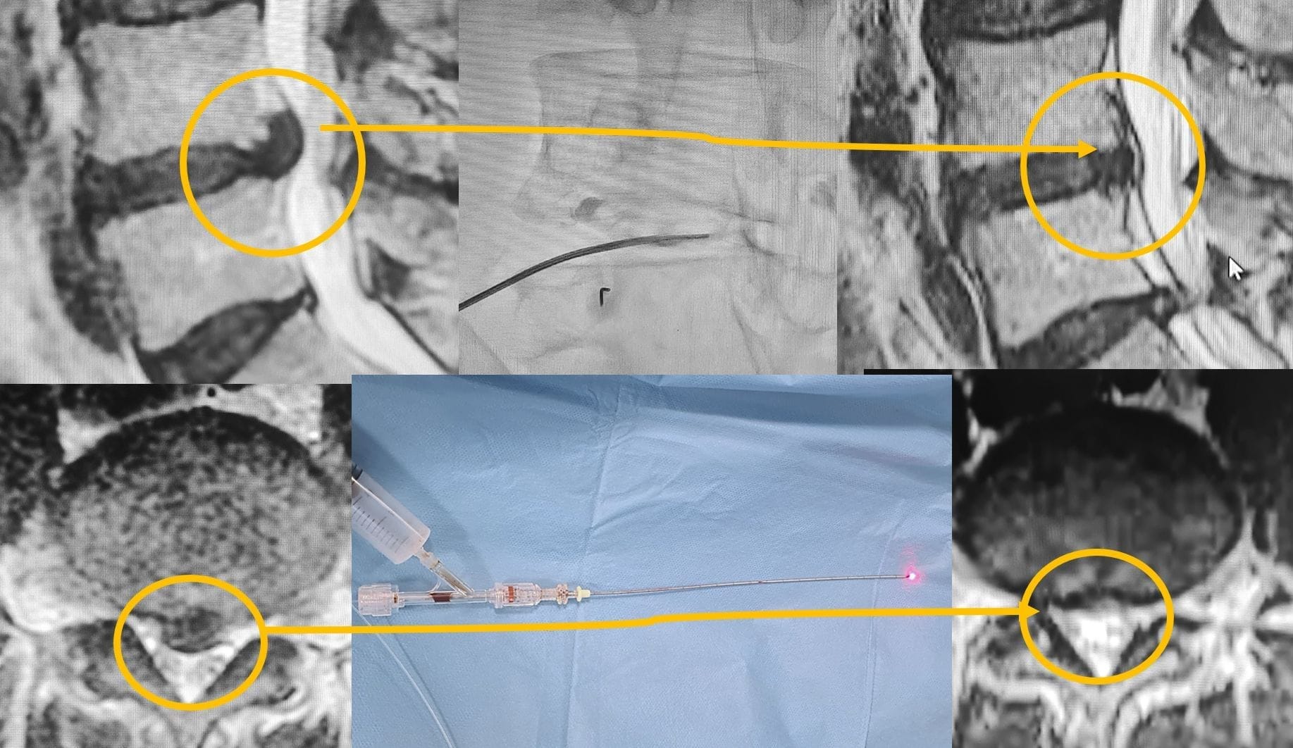 Behandlung von Bandscheibenvorfällen in der Lenden- und Halswirbelsäule ohne Operation (Regressionstherapie) DISK LAZER DİSK LAZER tedavi görüntüsü