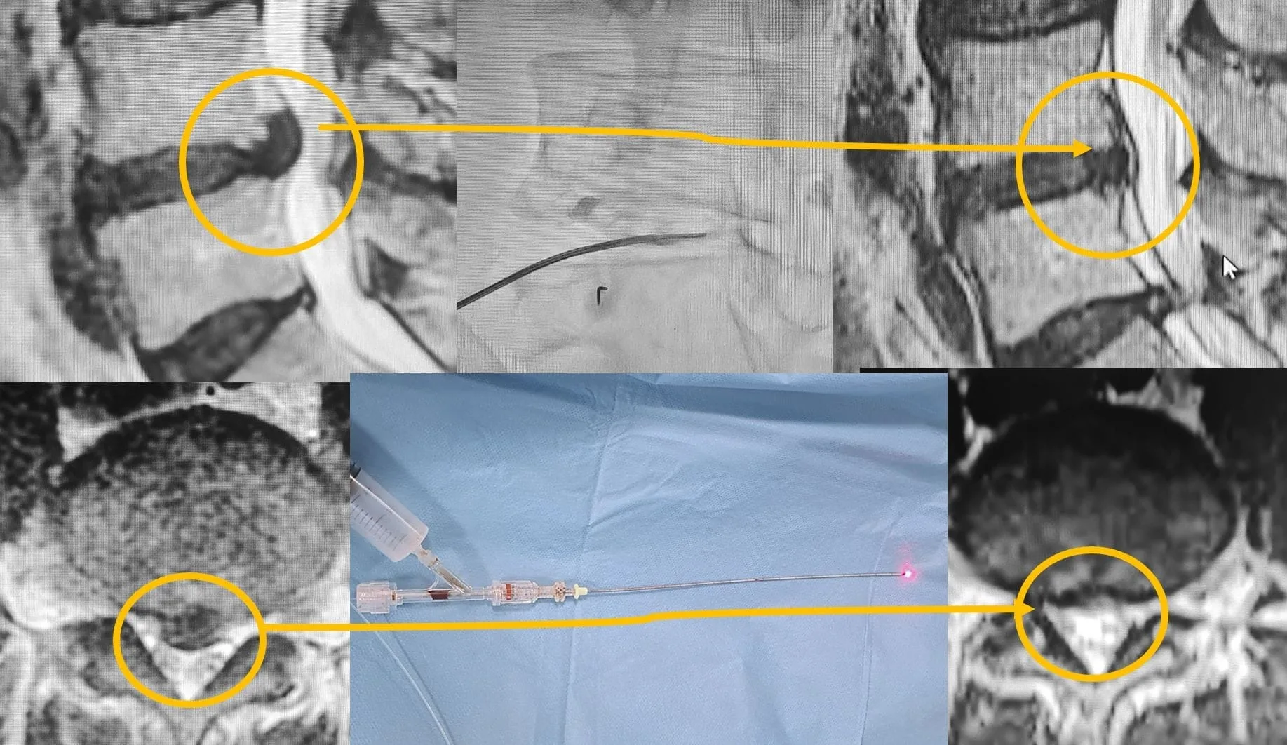 Non-Surgical Lumbar and Cervical Disc Herniation Treatment: Regression Therapy DISK LAZER Laser discectomy image