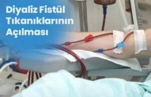 Deschiderea blocajelor fistulelor de dializă Diyaliz Fistul Tikaniklarinin Acilmasi