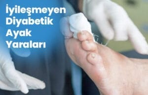 Răni ale piciorului diabetic care nu se vindecă Iyilesmeyen Diyabetik Ayak Yaralari