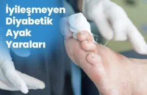 Non-Healing Diabetic Foot Wounds: Causes, Symptoms and Treatment Options Iyilesmeyen Diyabetik Ayak Yaralari