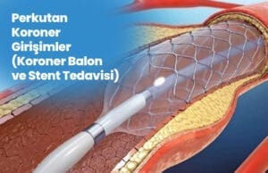 Aplicații cu balon și stent Perkutan Koroner Girisimler Koroner Balon ve Stent Tedavisi