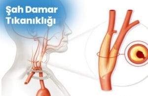 Tratament nechirurgical pentru ocluzia arterei carotide Sah Damar Tikanikligi