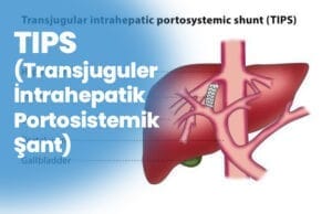 SFATURI (sunt portosistemic intrahepatic transjugular) TIPS Transjuguler Intrahepatik Portosistemik Sant