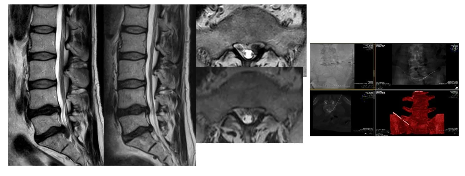 Non-Surgical Lumbar and Cervical Disc Herniation Treatment: Regression Therapy fitik kucultme regresyon tedavisi goruntusu Disc regression therapy image