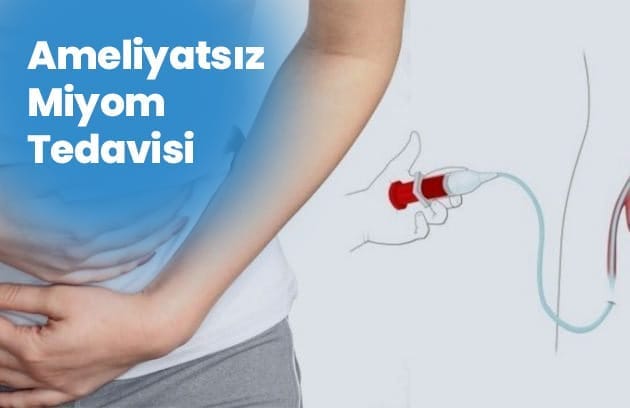 Homepage Ameliyatsiz Miyom Tedavisi 1 Homepage Ameliyatsiz Miyom Tedavisi 1