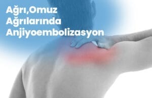 Omuz Ağrılarında Anjiyoembolizasyon Omuz Agrilarinda Anjiyoembolizasyon 1