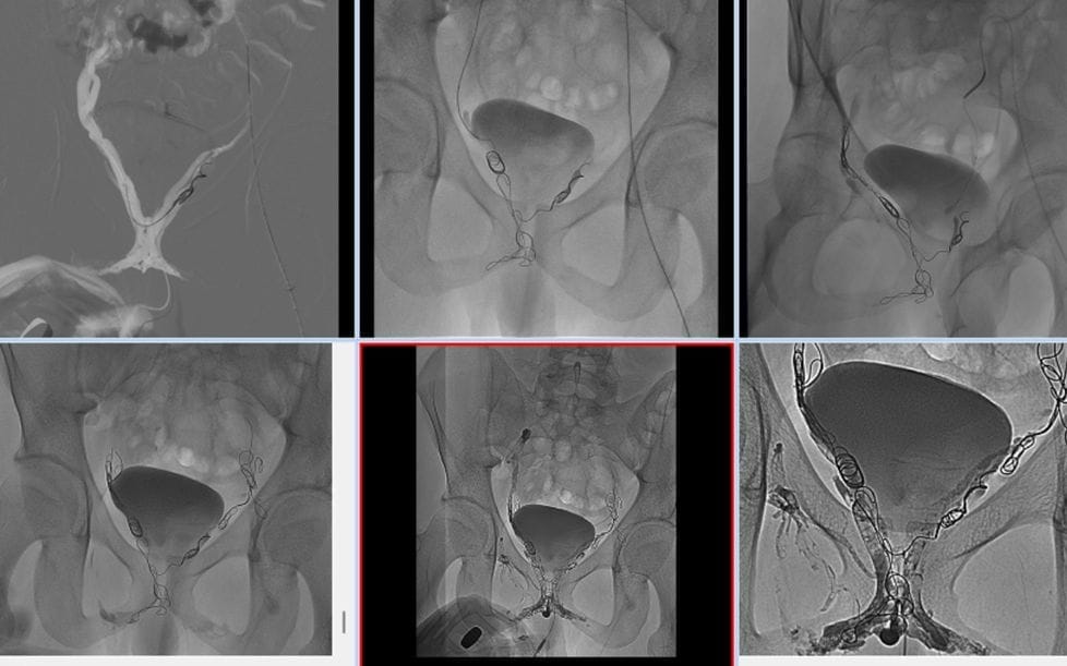 Tratament nechirurgical pentru scurgerile venoase ale penisului penil venoz kacak kapama 2 imagine de închidere a leak-ului venos penian