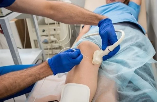Schmerzbehandlung mit Radiofrequenz Agrida Radyofrekans Ablasyon 1