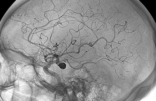 Embolisation Embolizasyon Tikama Tedavisi 1