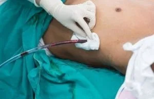 Torasentez Nedir? Göğüs İçi Sıvı Nasıl Boşaltılır? Gogus Ici Sivi Bosaltilmasi Torasentez 4