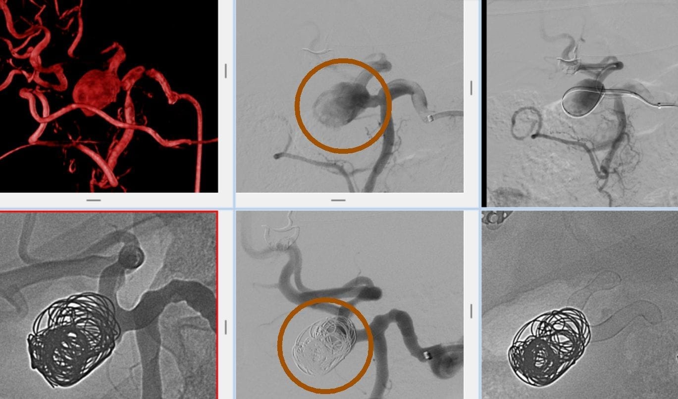 Embolisation KARACIGER DAMAR ANEVRIZMA TEDAVISI Embolisation KARACIGER DAMAR ANEVRIZMA TEDAVISI