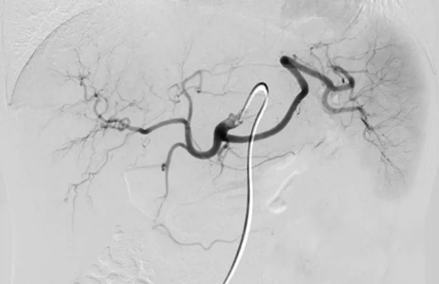 Chemoembolization (TACE): Procedure, Benefits, Risks and Recovery Kemoembolizasyon Transarteryel Kemoembolizasyon TAKE 1