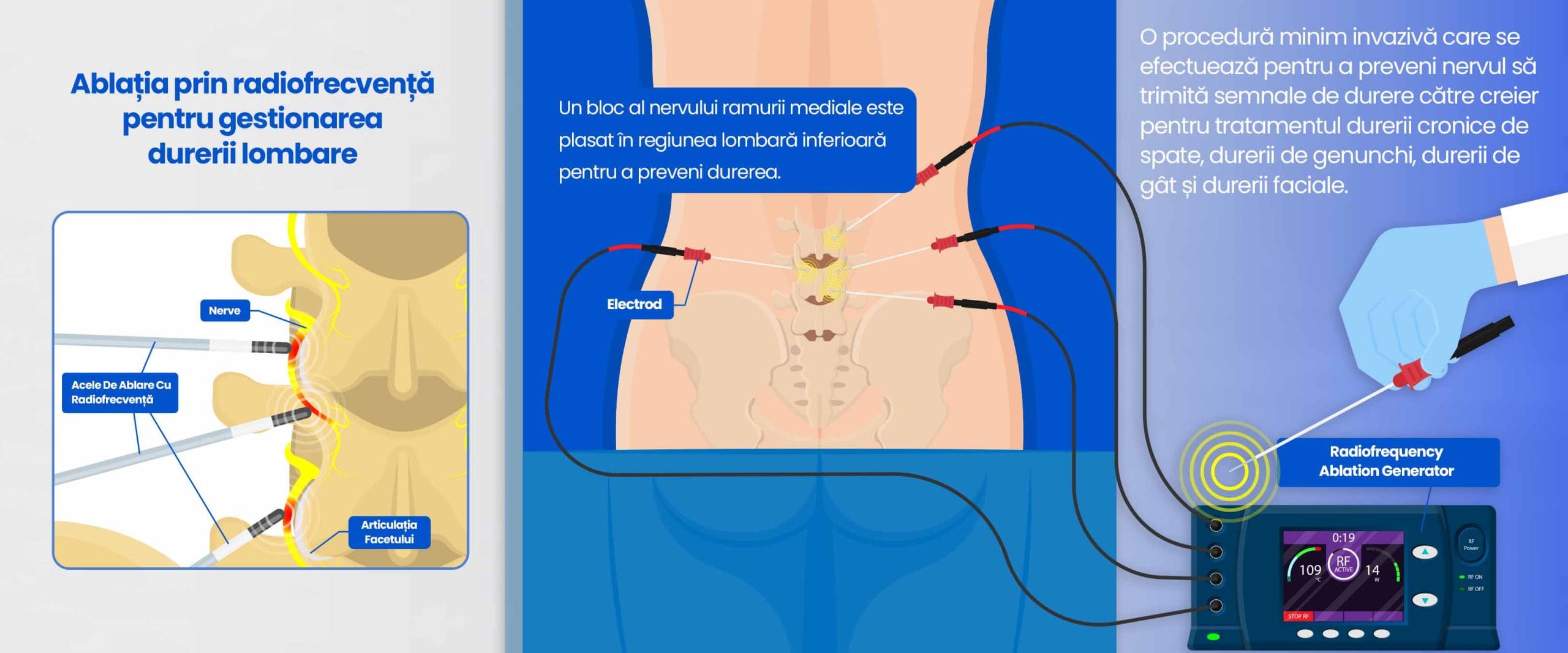 Tratamentul durerii cu radiofrecvență Radyofrekans Ablasyonu Ile Bel Agrisi Yonetimi RO scaled Tratamentul durerii cu radiofrecvență Radyofrekans Ablasyonu Ile Bel Agrisi Yonetimi RO scaled