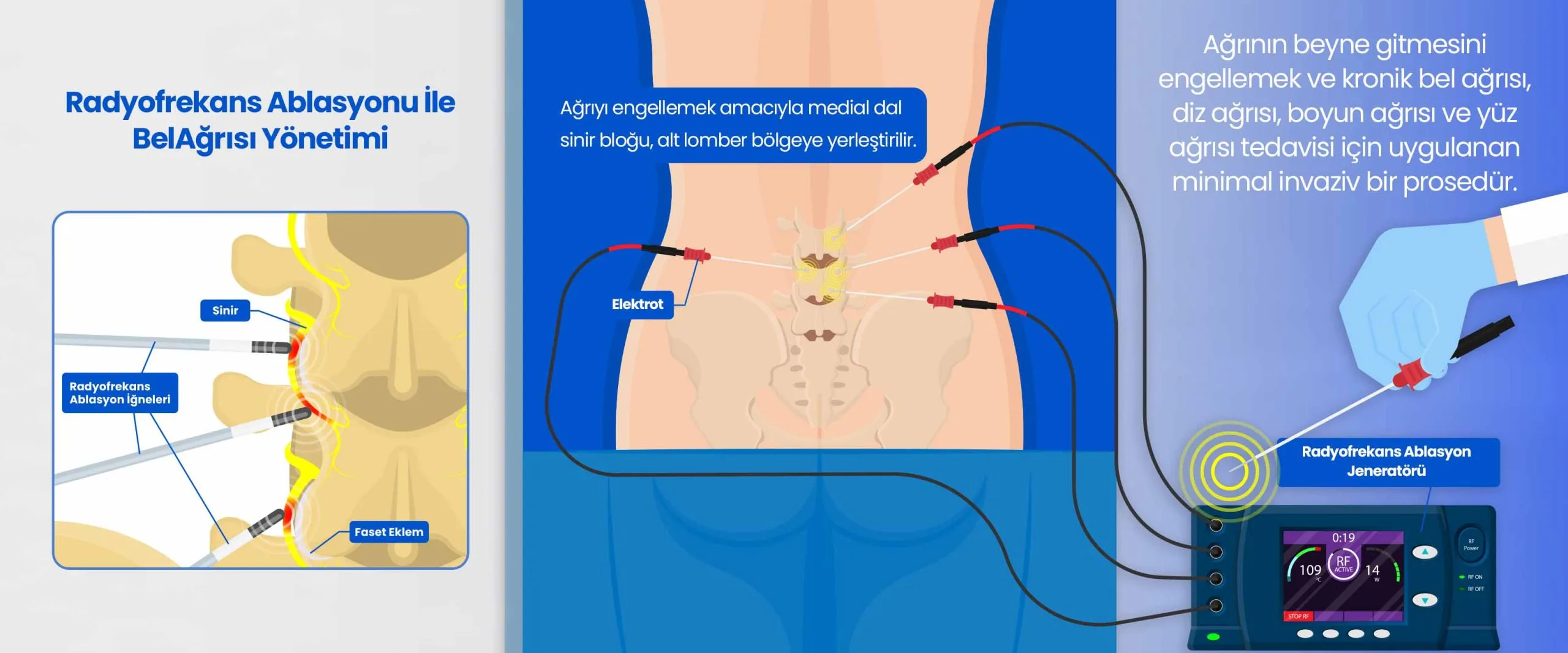Radiofrequency Ablation for Chronic Pain: Procedure, Benefits and Risks Radyofrekans Ablasyonu Ile Bel Agrisi Yonetimi TR scaled Radiofrequency Ablation for Chronic Pain: Procedure, Benefits and Risks Radyofrekans Ablasyonu Ile Bel Agrisi Yonetimi TR scaled