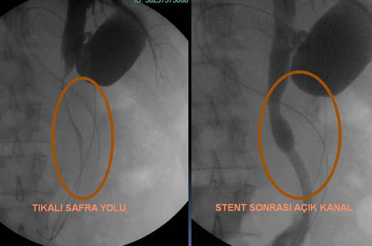 Plasarea stentului biliar în icterul obstructiv SAFRA KANALI STENT Imagine plasare stent biliar înainte și după