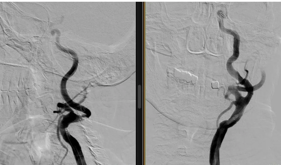 Behandlung von Karotisstenosen (Verengung der Halsschlagader) mit Stent karotis stentleme islemi goruntusu Bild des Stentings der Halsschlagader