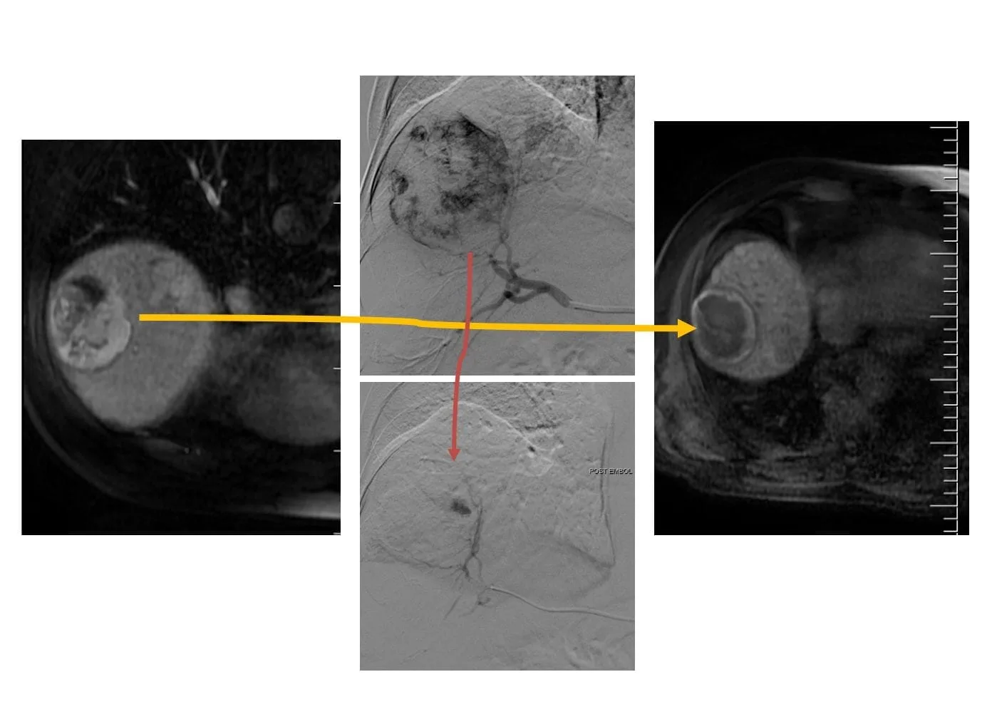 Chemoembolisation take Foto der TACE-Behandlung