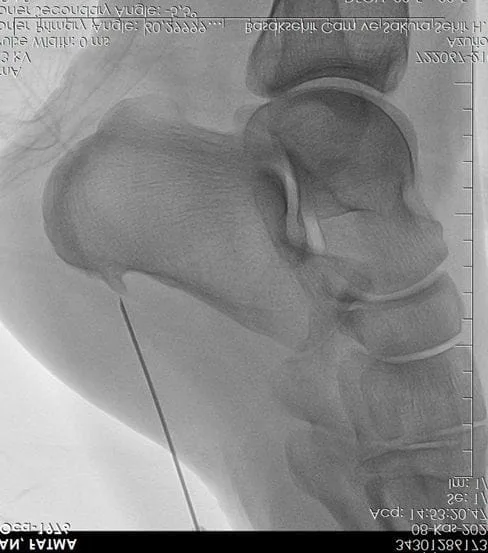 Tratament Heel Spur cu radiofrecvență topuk dikeni radyofrekans tedavisi goruntusu topuk dikeni radyofrekans tedavisi görüntüsü