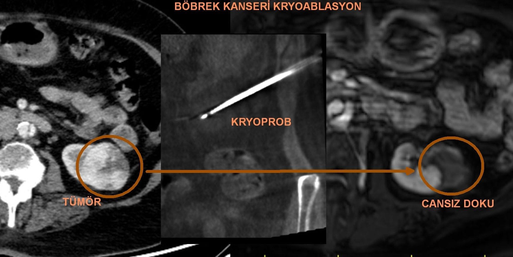 Kryoablation (Kälteablation) BOBREK TUMORU KRYOABLASYON BÖBREK TÜMÖR KRYOABLATION