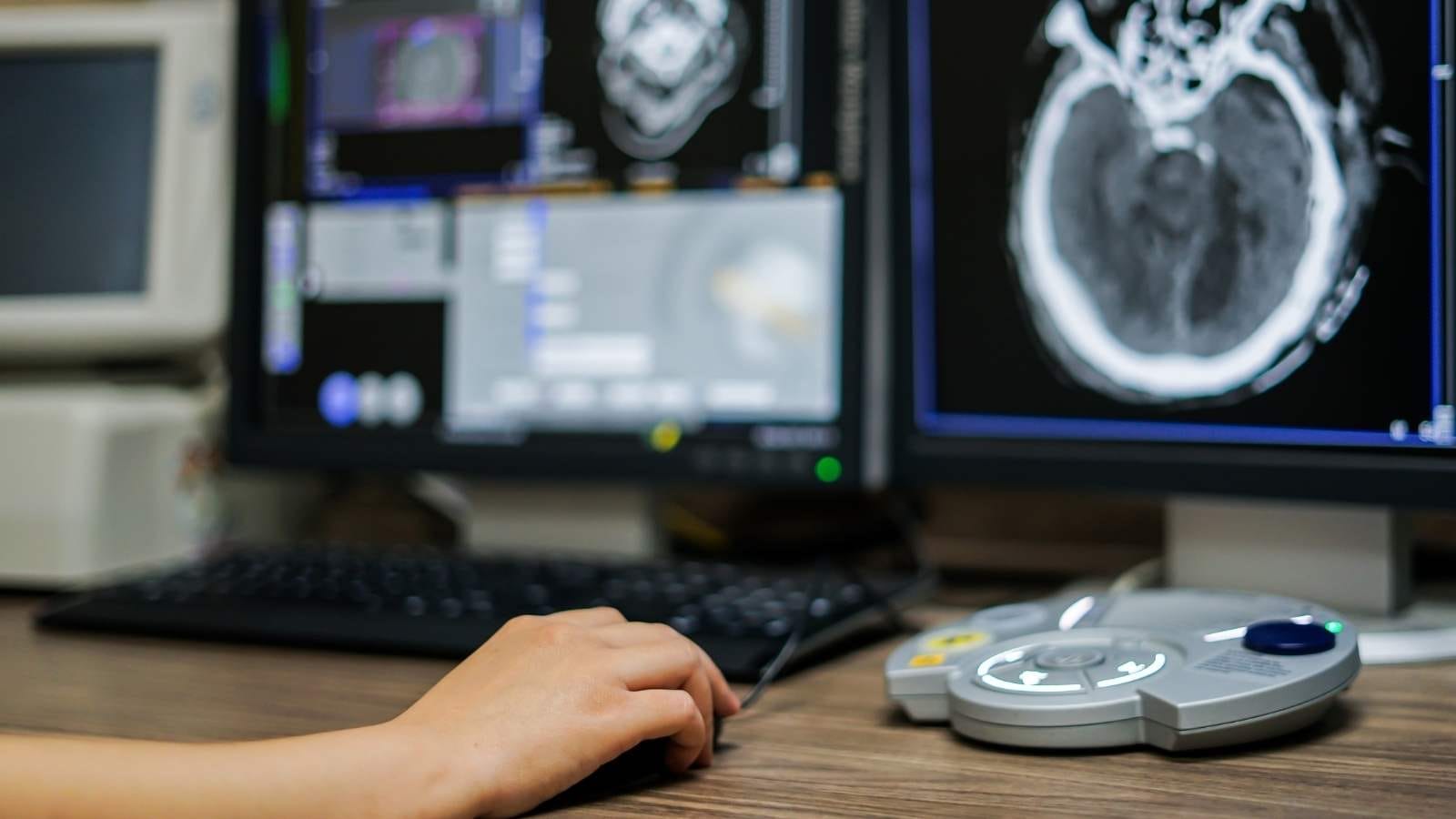 Embolization Treatment Prices in Turkey, USA, UK & CANADA Embolizasyon fiyatlari