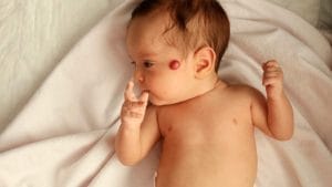 Hämangiom (Blutschwamm) Hemanjiom