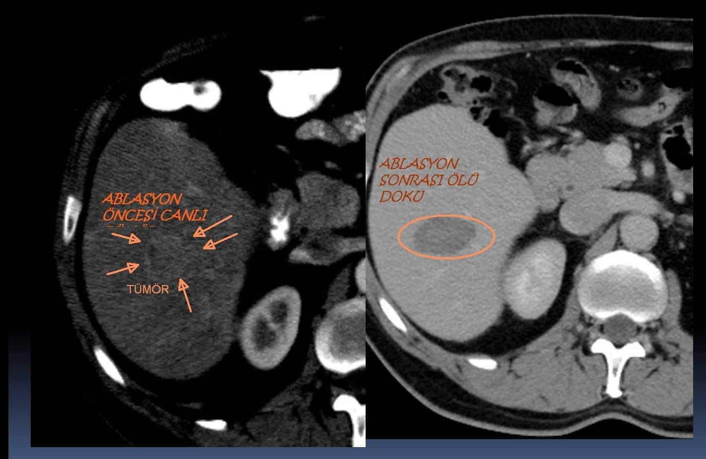 Karaciğer Tümör Ablasyon Tedavisi KARACIGER KITLE ABLASYON KARACİĞER KİTLE ABLASYONU
