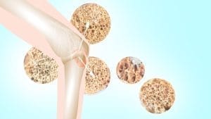 Kemik Biyopsisi Nedir? Nasıl Yapılır? Neden Yapılır? Kemik Biyopsisi Kemik Biyopsisi Nedir? Nasıl Yapılır? Neden Yapılır? Kemik Biyopsisi