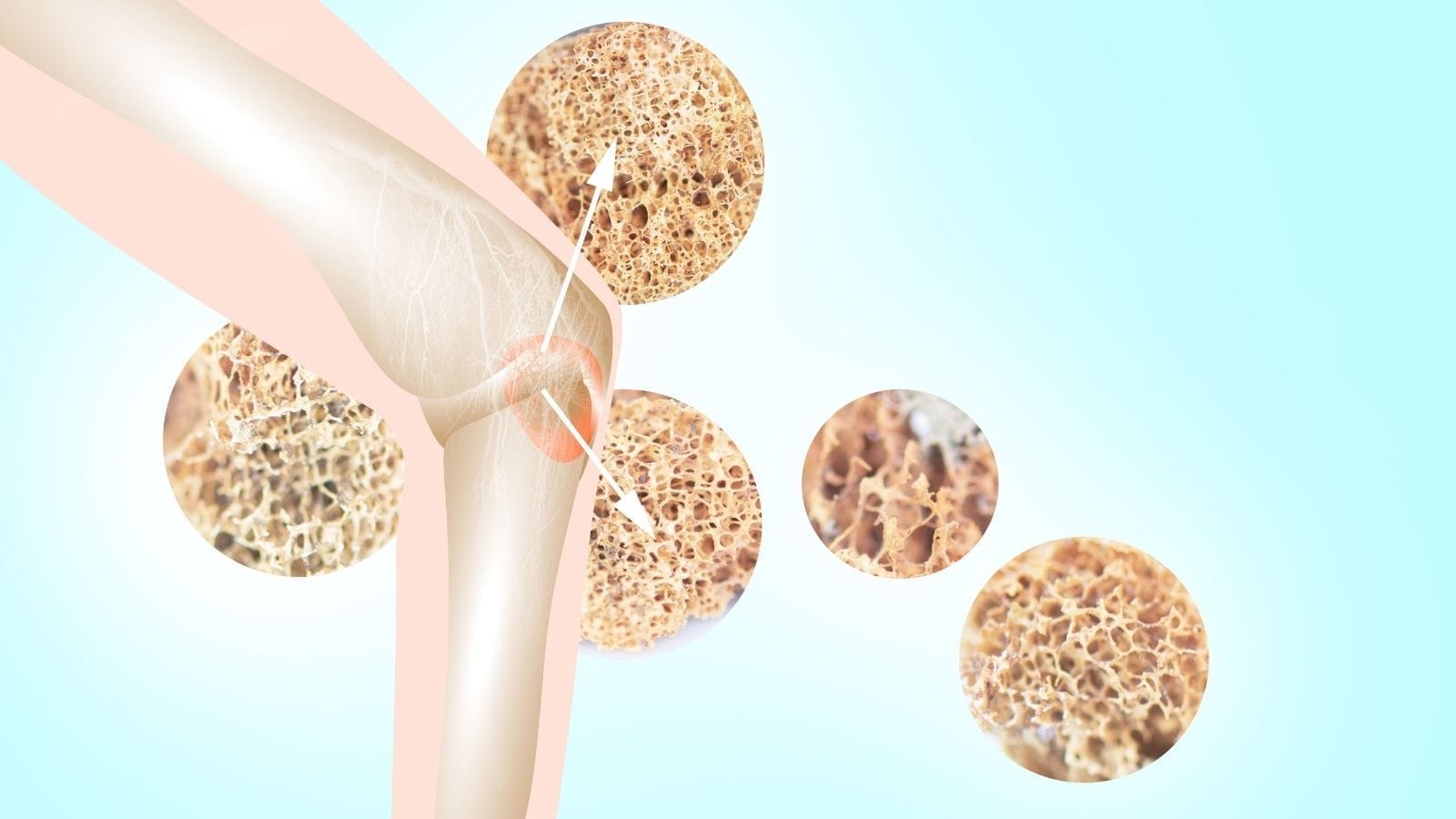 Kemik Biyopsisi Nedir? Nasıl Yapılır? Neden Yapılır? Kemik Biyopsisi Kemik Biyopsisi Nedir? Nasıl Yapılır? Neden Yapılır? Kemik Biyopsisi