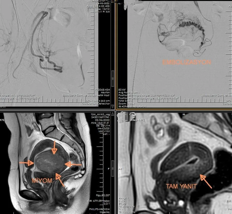 Uterine Fibroid Embolization (Myoma Embolization): Procedure, Benefits and Recovery MIYOM EMBOLIZASYONU TAM YANITLI Pre- and post-procedure images of fibroid embolization